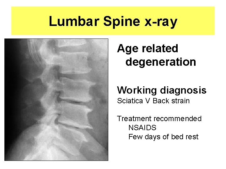 Lumbar Spine x-ray Age related degeneration Working diagnosis Sciatica V Back strain Treatment recommended