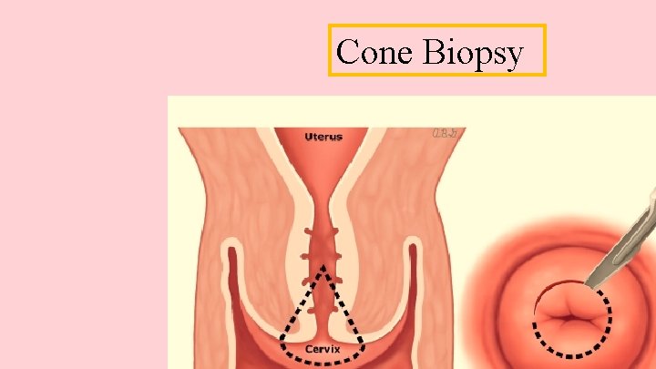 Cone Biopsy 