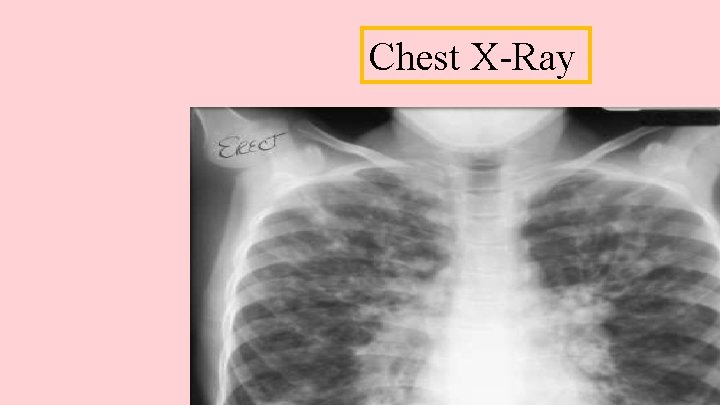 Chest X-Ray 