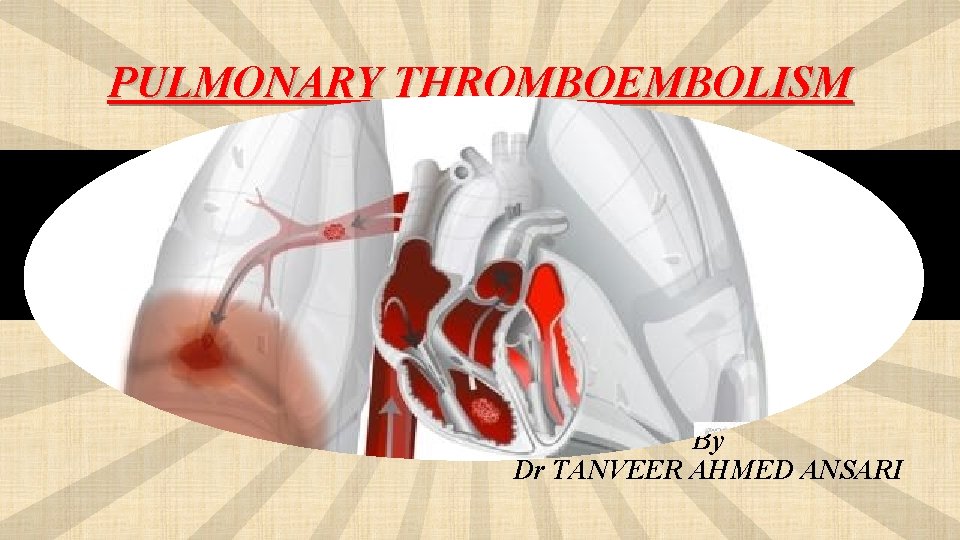 PULMONARY THROMBOEMBOLISM By Dr TANVEER AHMED ANSARI 