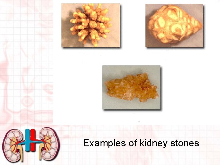 Examples of kidney stones 