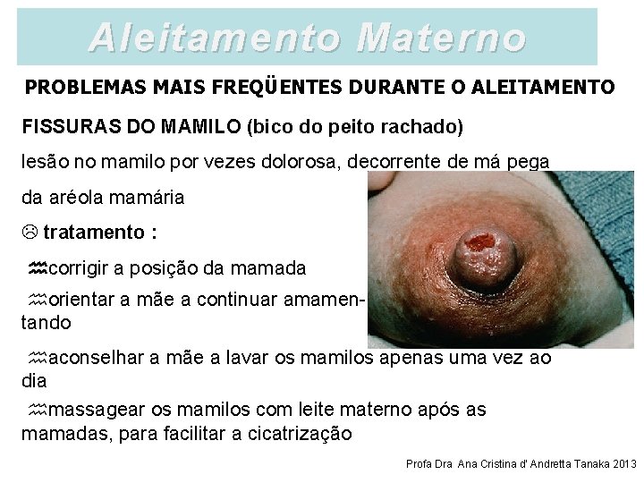 Aleitamento Materno PROBLEMAS MAIS FREQÜENTES DURANTE O ALEITAMENTO FISSURAS DO MAMILO (bico do peito