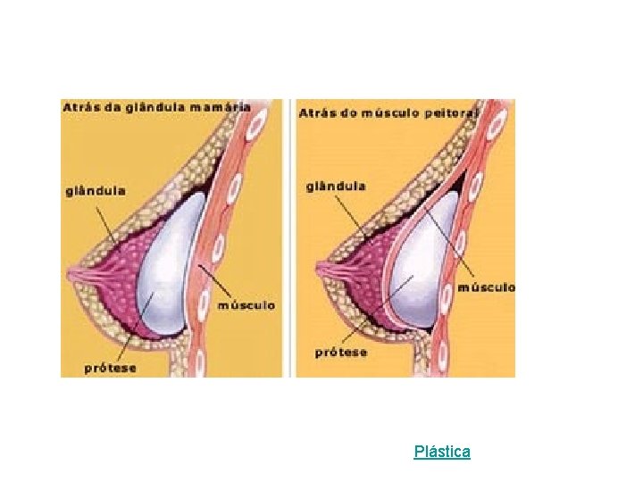 Plástica 