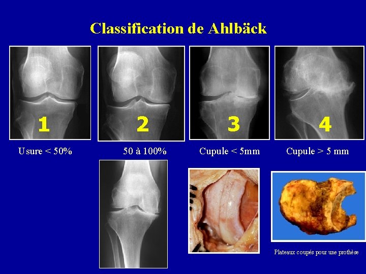 Classification de Ahlbäck 1 2 Usure < 50% 50 à 100% 3 Cupule <