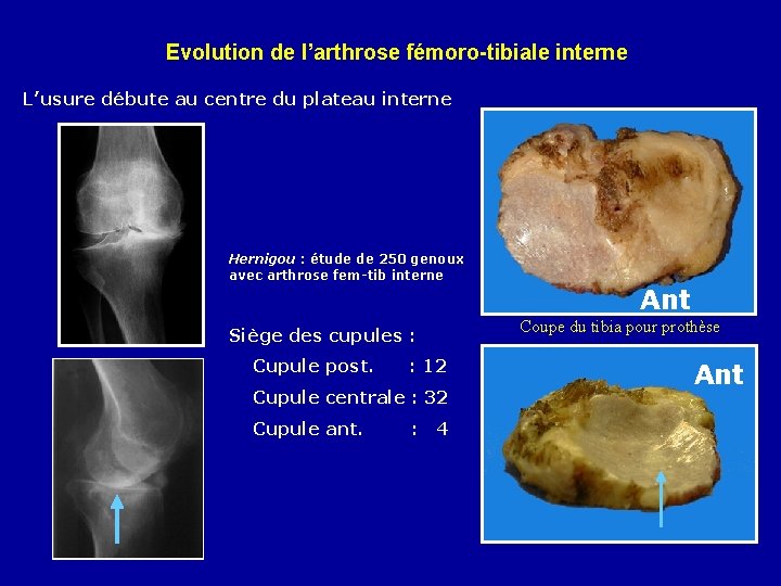 Evolution de l’arthrose fémoro-tibiale interne L’usure débute au centre du plateau interne Hernigou :