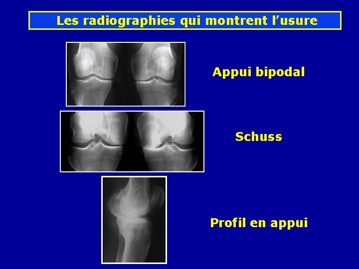 Les radiographies qui montrent l’usure Appui bipodal Schuss Profil en appui 