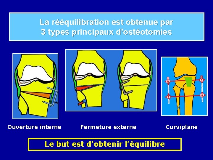 La rééquilibration est obtenue par 3 types principaux d’ostéotomies Ouverture interne Fermeture externe Le