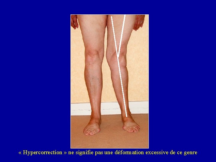  « Hypercorrection » ne signifie pas une déformation excessive de ce genre 
