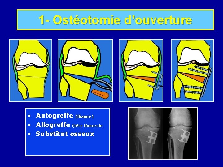 1 - Ostéotomie d’ouverture • Autogreffe (iliaque) • Allogreffe (tête fémorale • Substitut osseux