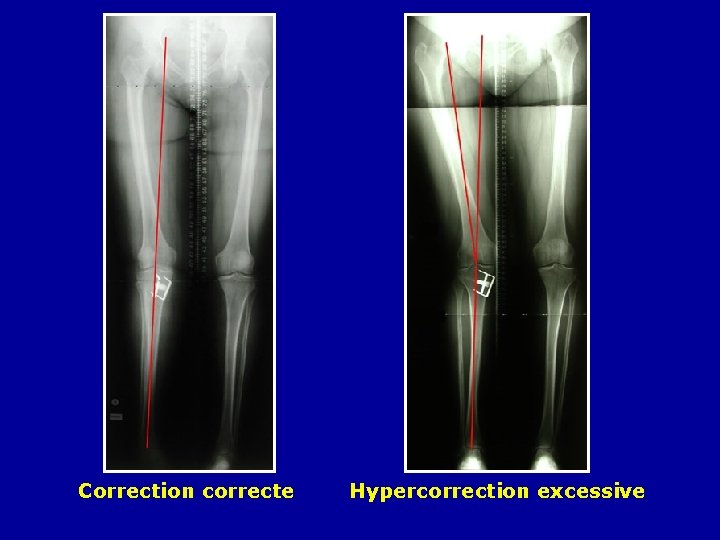 Correction correcte Hypercorrection excessive 