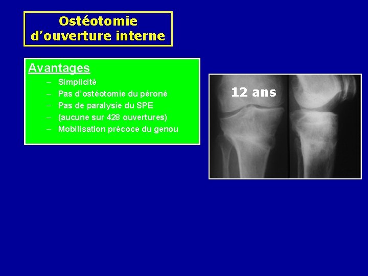 Ostéotomie d’ouverture interne Avantages – – – Simplicité Pas d’ostéotomie du péroné Pas de