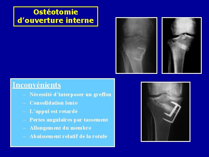 Ostéotomie d’ouverture interne Inconvénients – – – Nécessité d’interposer un greffon Consolidation lente L’appui