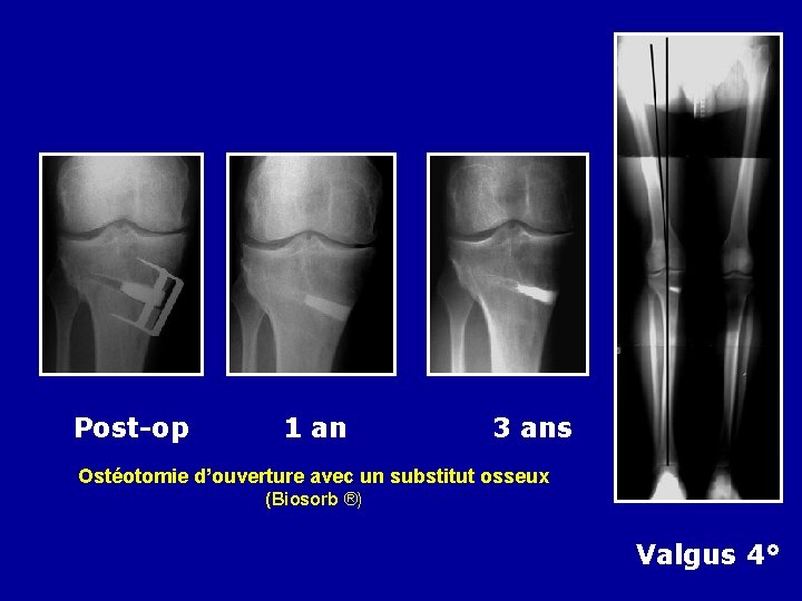 Post-op 1 an 3 ans Ostéotomie d’ouverture avec un substitut osseux (Biosorb ®) Valgus