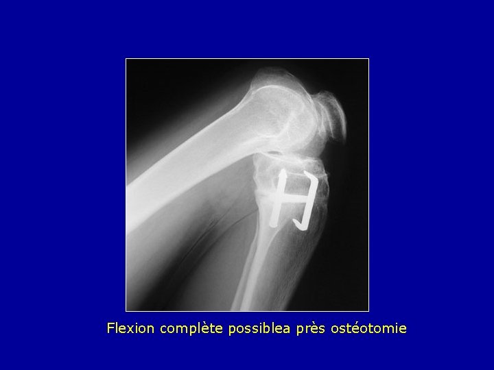 Flexion complète possiblea près ostéotomie 