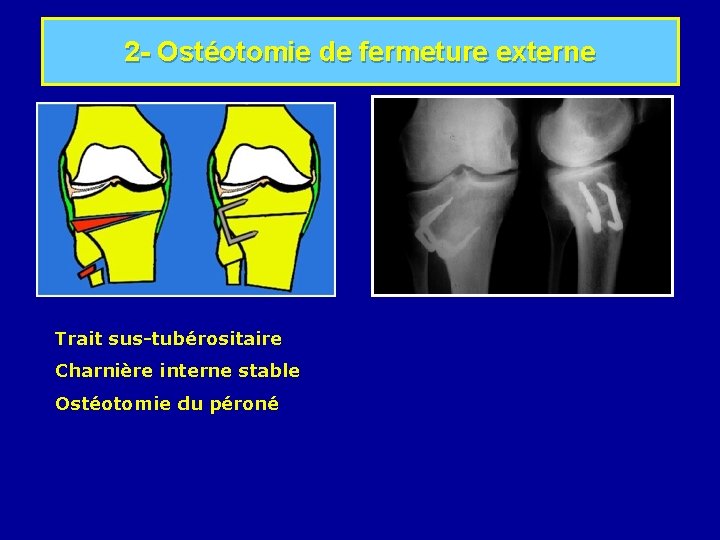 2 - Ostéotomie de fermeture externe Trait sus-tubérositaire Charnière interne stable Ostéotomie du péroné
