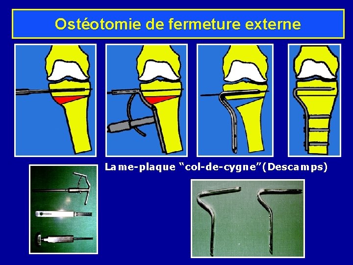 Ostéotomie de fermeture externe Lame-plaque “col-de-cygne”(Descamps) 