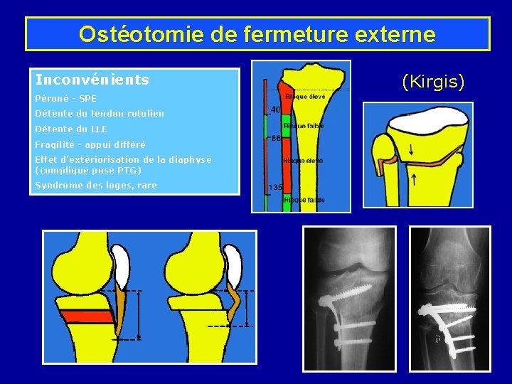 Ostéotomie de fermeture externe Inconvénients Péroné - SPE Détente du tendon rotulien Détente du