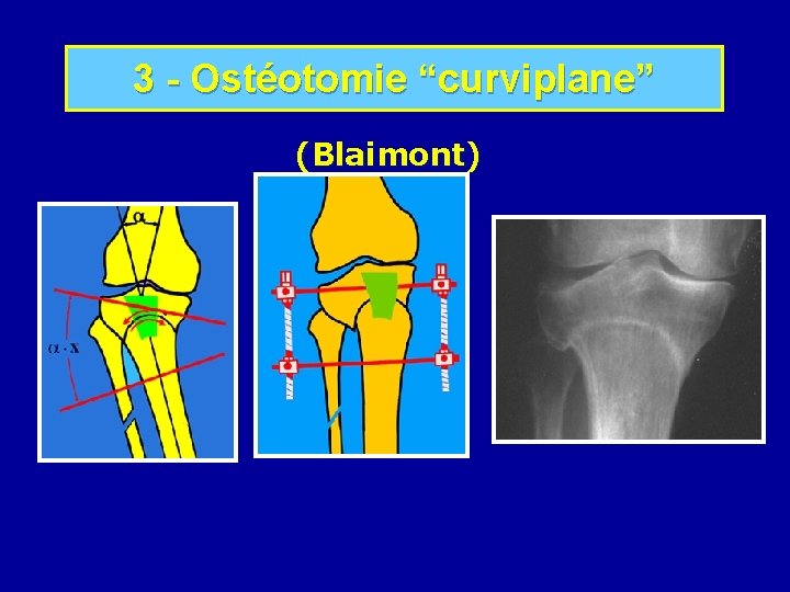 La gonarthrose LA GONARTHROSE Arthrose du genou Arthrose