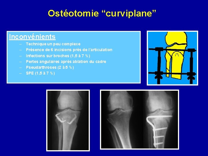 Ostéotomie “curviplane” Inconvénients – – – Technique un peu complexe Présence de 6 incisions