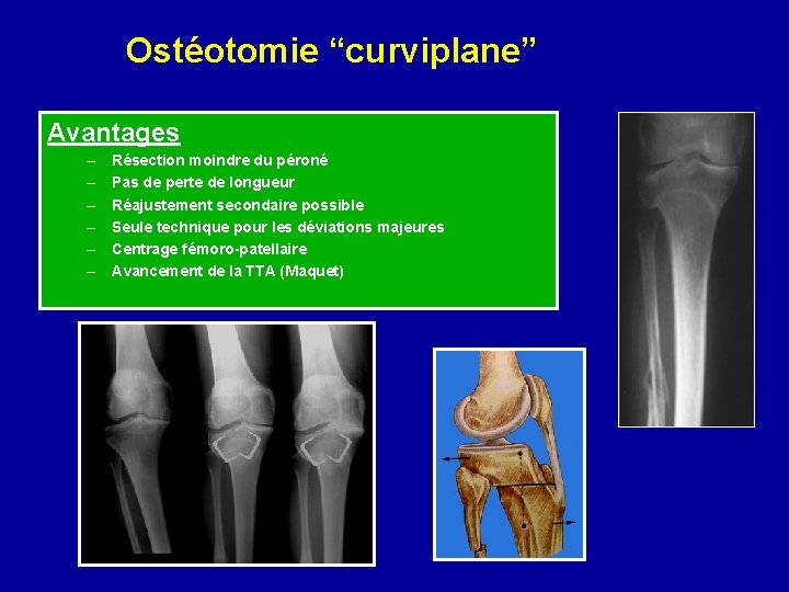 Ostéotomie “curviplane” Avantages – – – Résection moindre du péroné Pas de perte de