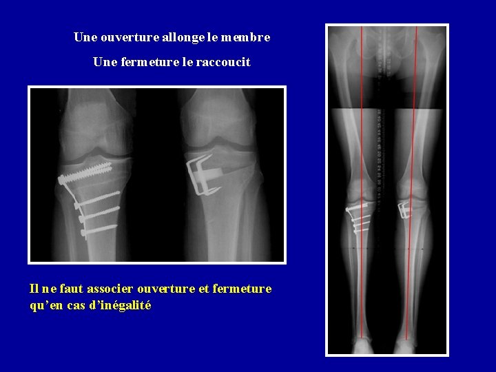 Une ouverture allonge le membre Une fermeture le raccoucit Il ne faut associer ouverture