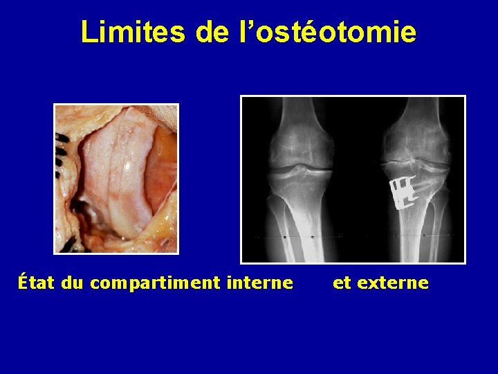 Limites de l’ostéotomie État du compartiment interne et externe 