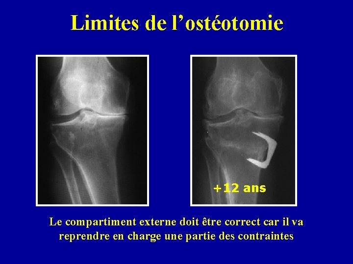Limites de l’ostéotomie +12 ans Le compartiment externe doit être correct car il va