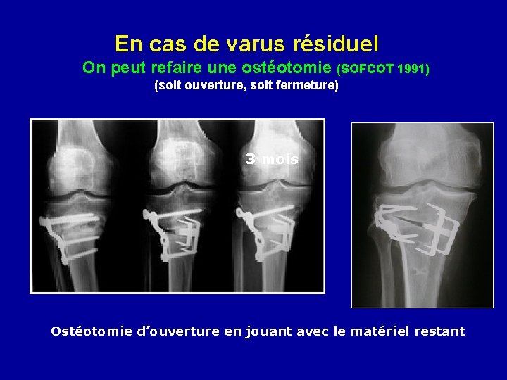 En cas de varus résiduel On peut refaire une ostéotomie (SOFCOT 1991) (soit ouverture,