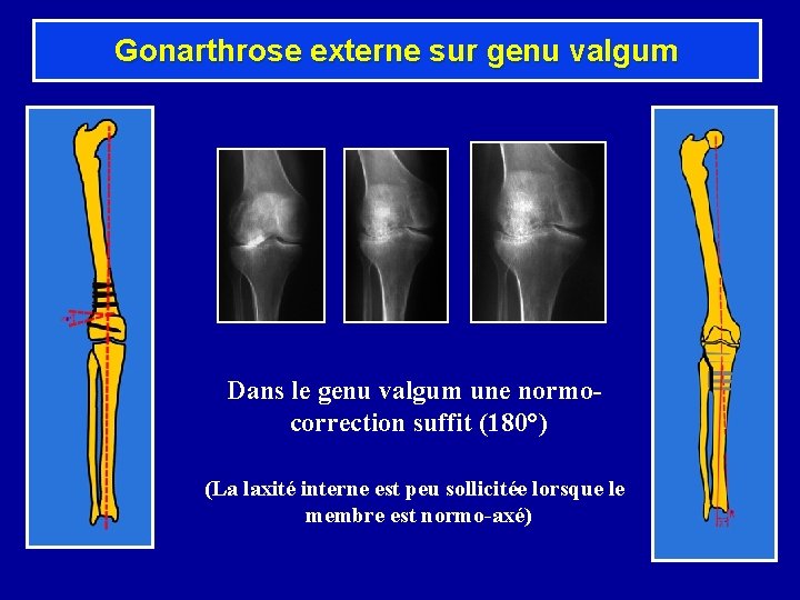 Gonarthrose externe sur genu valgum Dans le genu valgum une normocorrection suffit (180°) (La