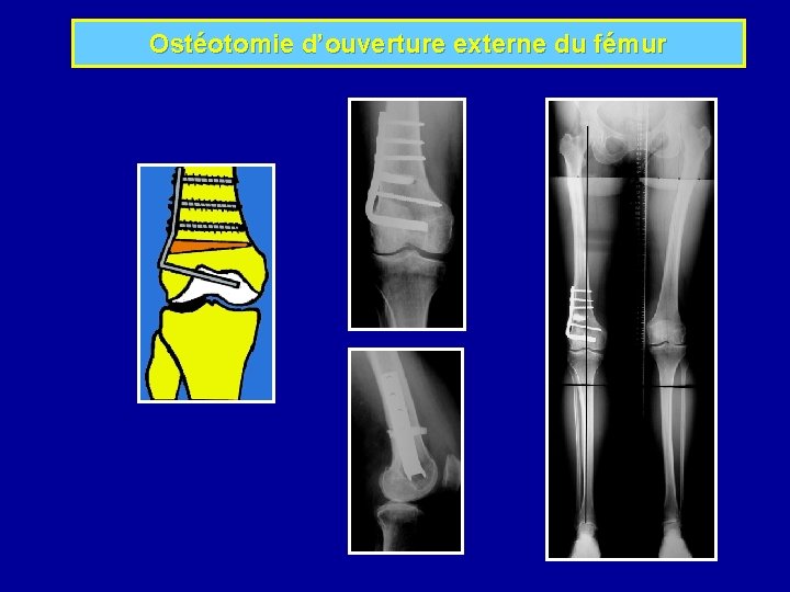 Ostéotomie d’ouverture externe du fémur 
