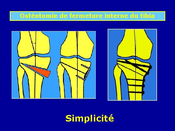 Ostéotomie de fermeture interne du tibia Simplicité 