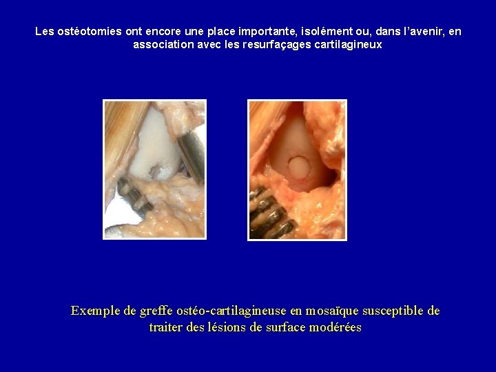 Les ostéotomies ont encore une place importante, isolément ou, dans l’avenir, en association avec