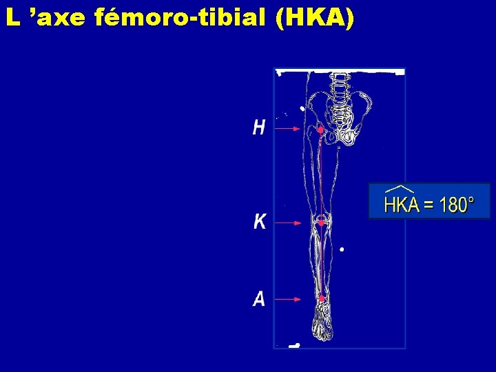 L ’axe fémoro-tibial (HKA) - normal : 180 ° - axe moyen : 173°