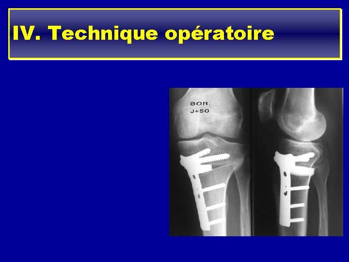 IV. Technique opératoire - 3 cm en dessous de l ’interligne interne - lame