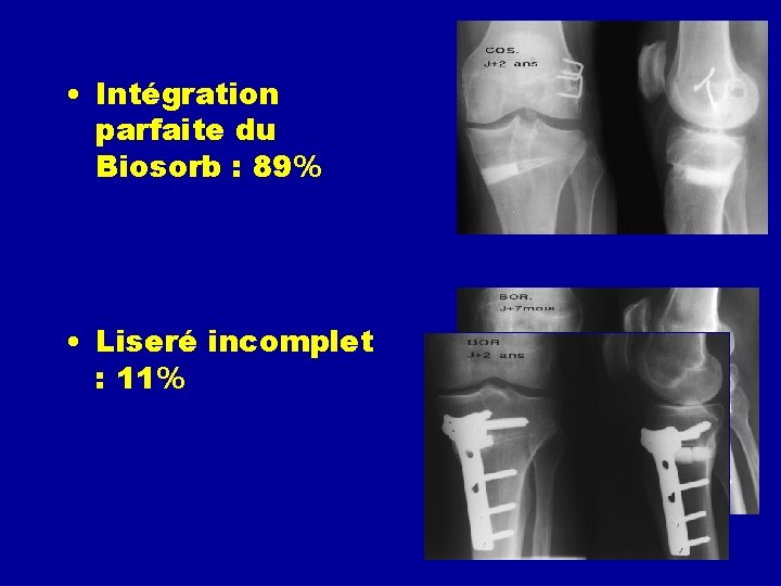  • Intégration parfaite du Biosorb : 89% • Liseré incomplet : 11% 