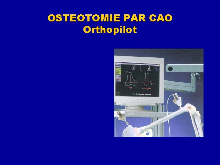 OSTEOTOMIE PAR CAO Orthopilot d. 38130, Échirolles. 