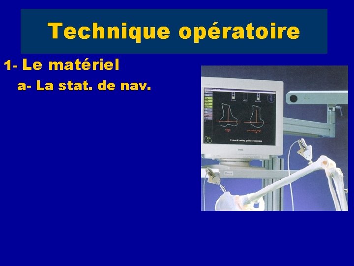 Technique opératoire 1 - Le matériel a- La stat. de nav. - Localisateur à