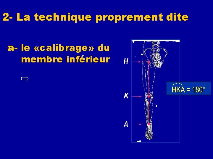 2 - La technique proprement dite a- le «calibrage» du membre inférieur recherche de