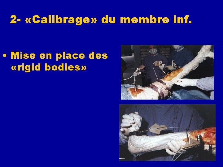 2 - «Calibrage» du membre inf. • Mise en place des «rigid bodies» -