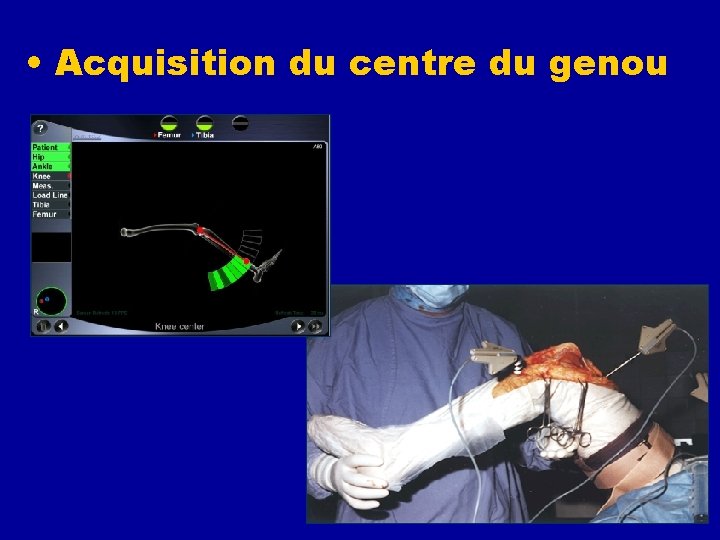  • Acquisition du centre du genou 
