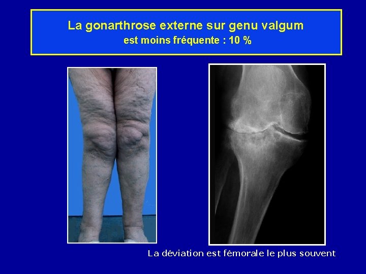 La gonarthrose externe sur genu valgum est moins fréquente : 10 % La déviation