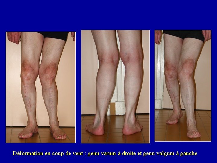 Déformation en coup de vent : genu varum à droite et genu valgum à