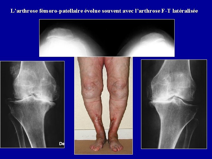 L’arthrose fémoro-patellaire évolue souvent avec l’arthrose F-T latéralisée 