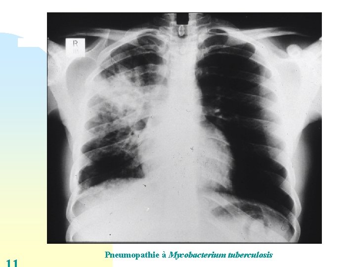 Pneumopathie à Mycobacterium tuberculosis 