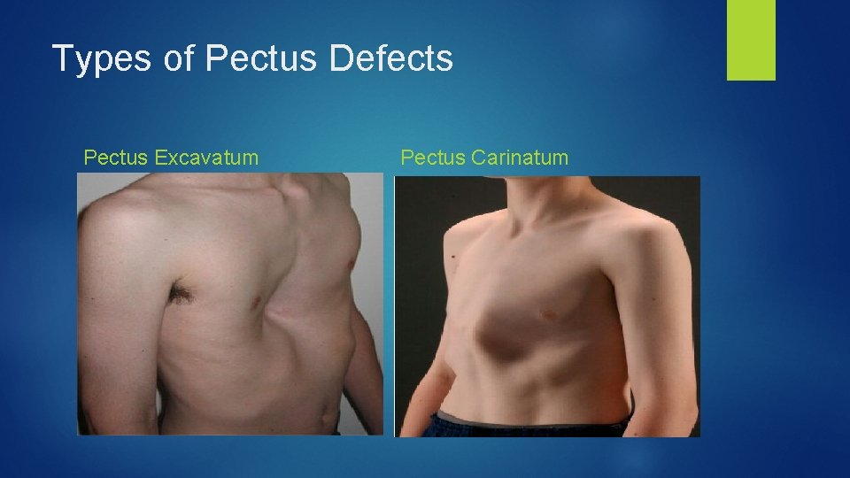 Types of Pectus Defects Pectus Excavatum Pectus Carinatum 