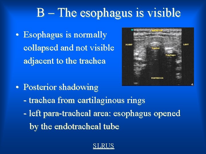B – The esophagus is visible • Esophagus is normally collapsed and not visible