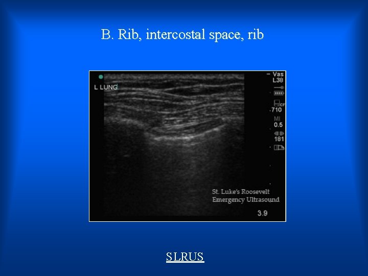 B. Rib, intercostal space, rib SLRUS 