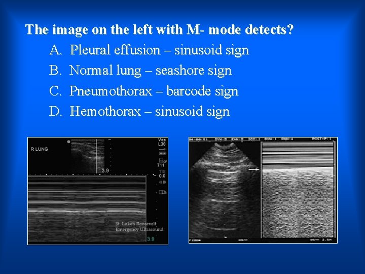 The image on the left with M- mode detects? A. Pleural effusion – sinusoid