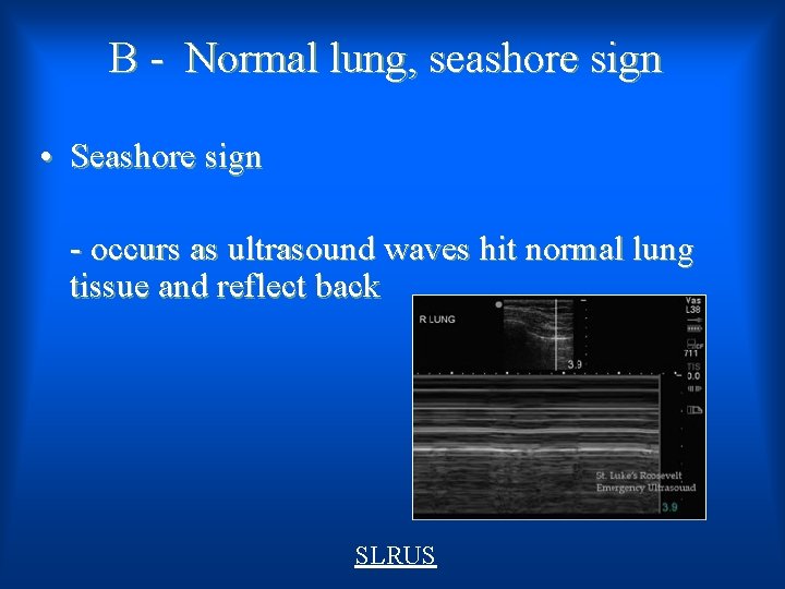 B - Normal lung, seashore sign • Seashore sign - occurs as ultrasound waves