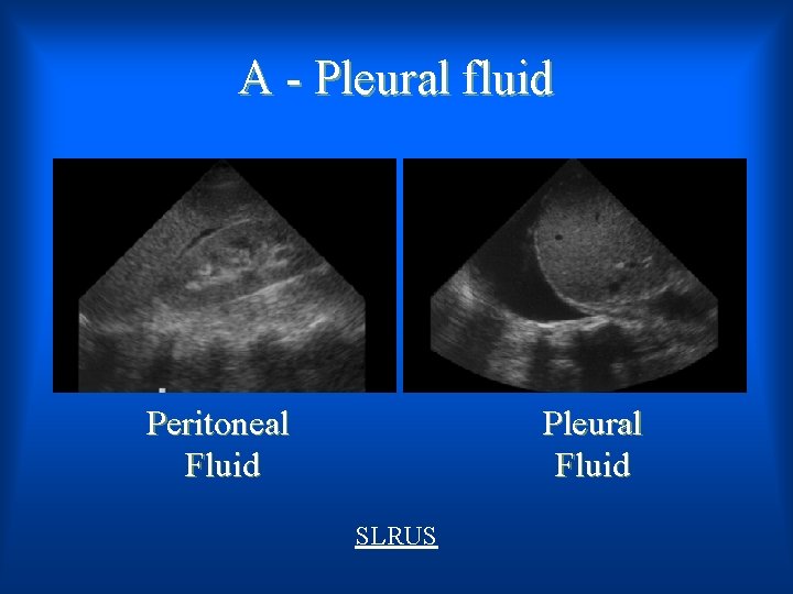 A - Pleural fluid Peritoneal Fluid Pleural Fluid SLRUS 